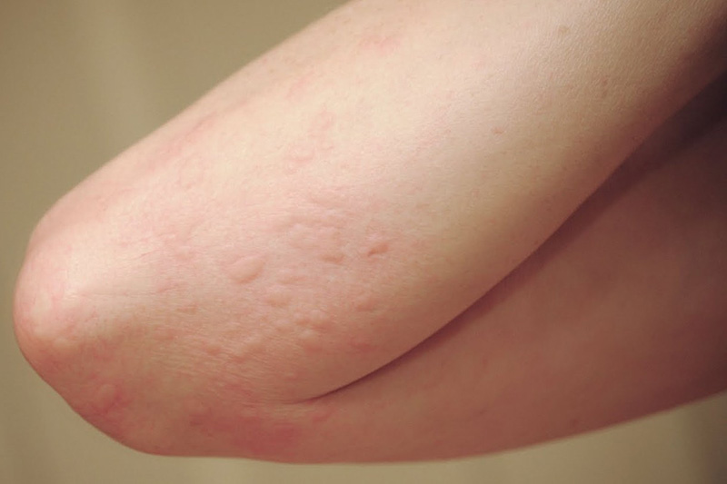 What Could Rash On Arms And Legs Mean