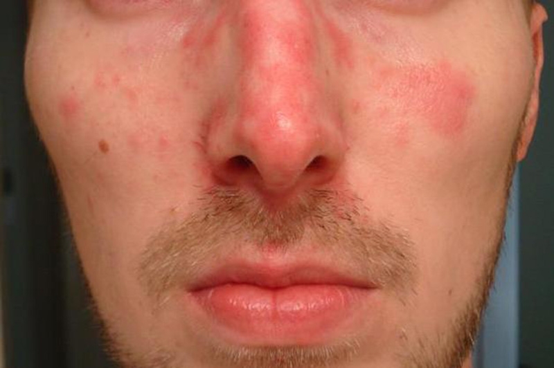 Rash On Face And Lips - Printable Templates Protal