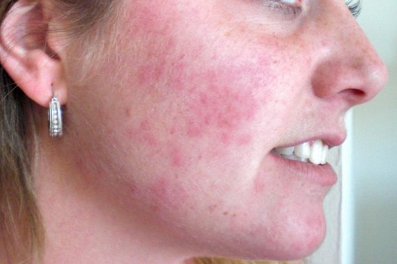 Can’t-Miss Takeaways Of Tips About How To Treat A Rash On Your Face ...