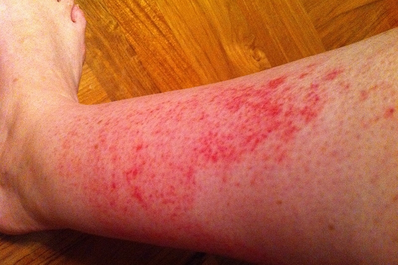 red rashes on lower leg pictures, photos