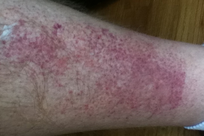 i-developed-a-rash-on-my-legs-that-was-itchy-a-few-hours-after