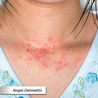 medicine for rash - pictures, photos