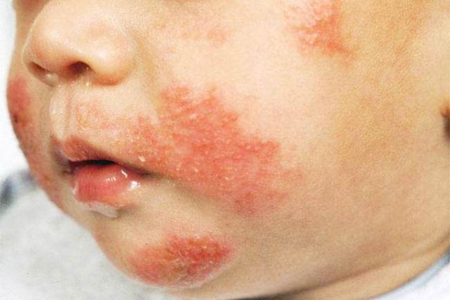 Rash On Baby Lips