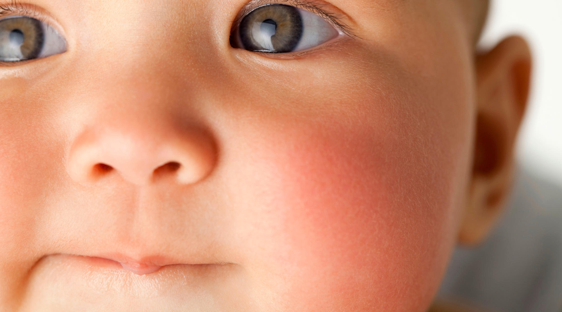 Fungal Rash On Face Child