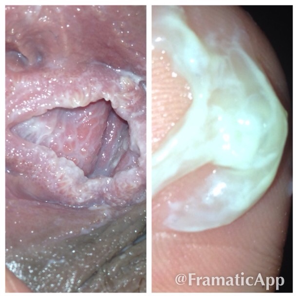 yeast infection rash on vag