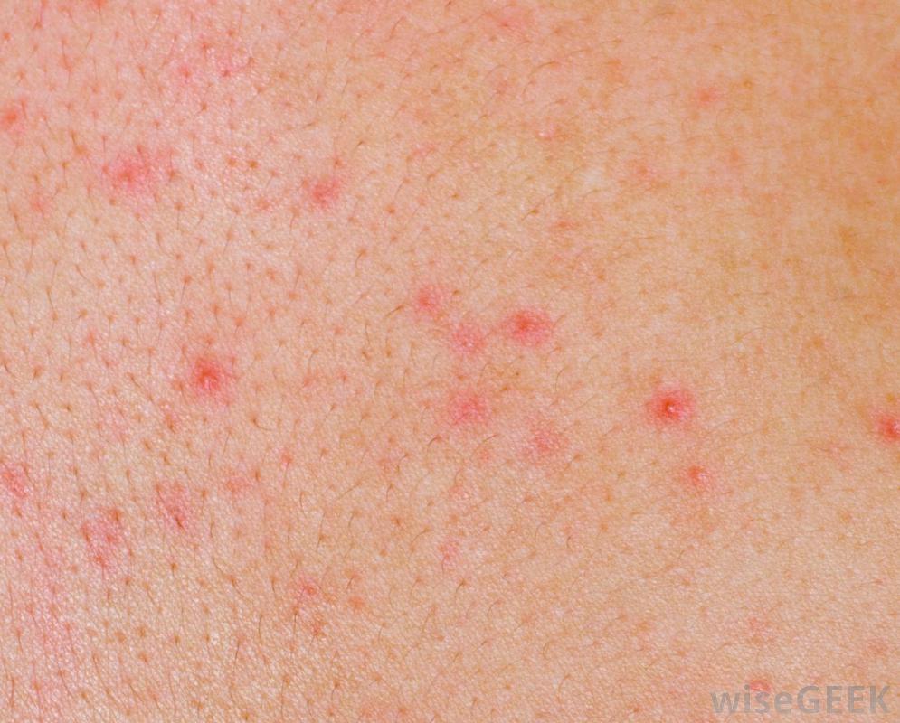 Itchy Rash On Stomach And Back Pictures Photos