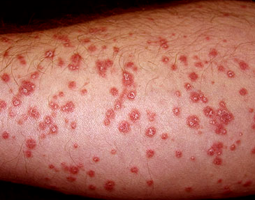 pinpoint red dots on arm pinpoint red dots on arm