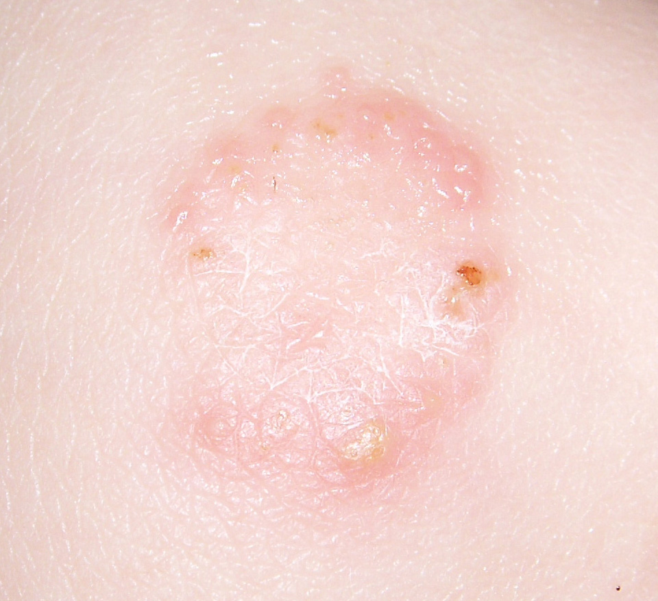 ringworm-rash-image-pictures-photos