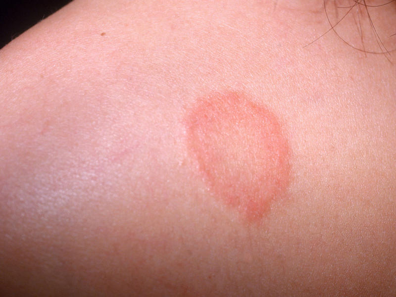 What Is A Red Circle Rash