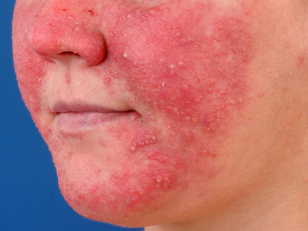 what is rosacea - pictures, photos