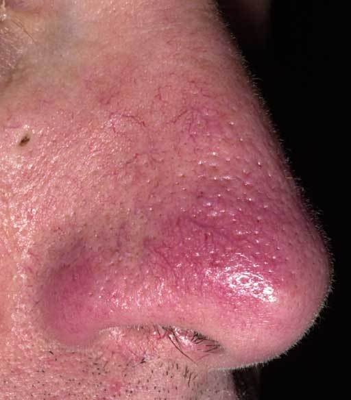 rosacea nose pictures - pictures, photos