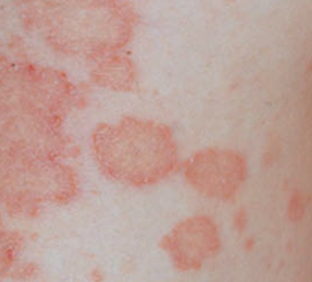 circular skin rash pictures