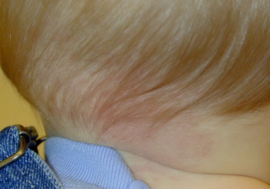 salmon patches pictures, photos