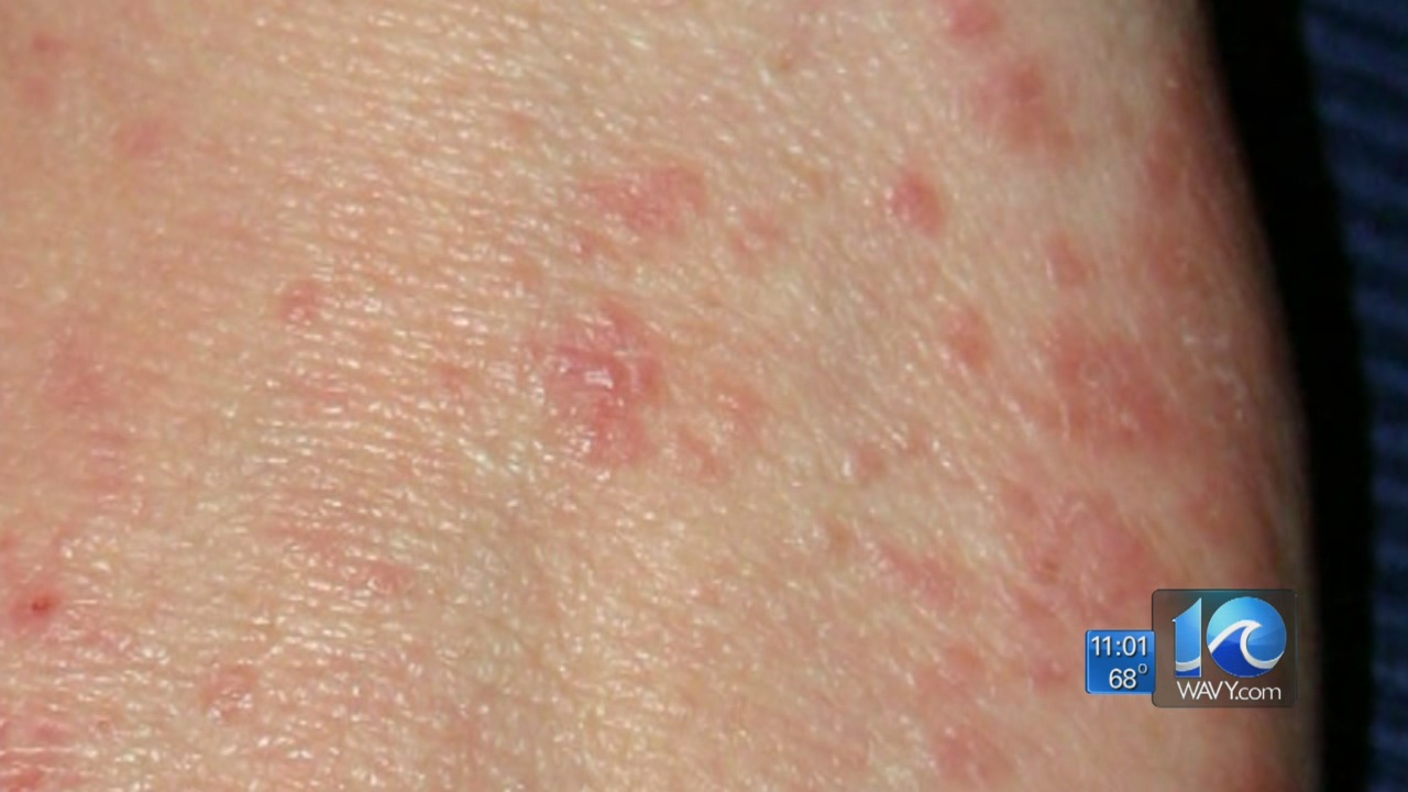swimmers itch symptoms
