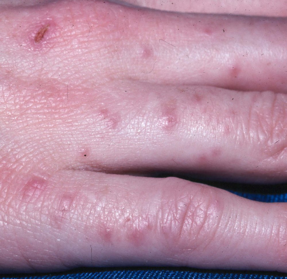 scabies on hands - pictures, photos