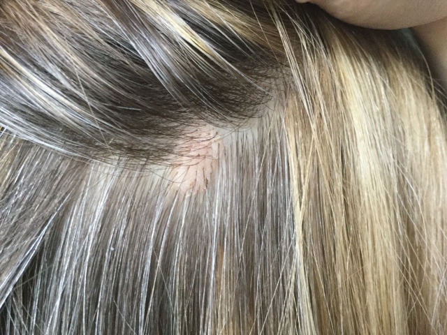 White Bumps On Head Scalp 