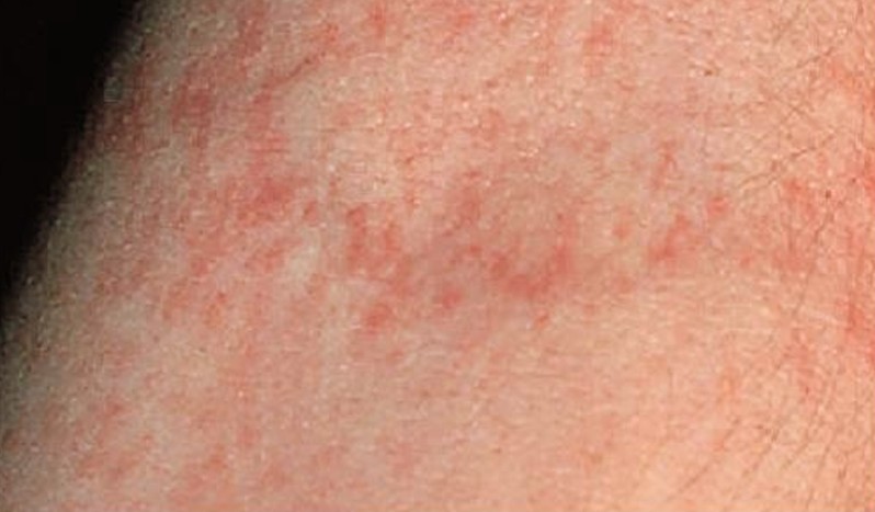 scarlet-fever-rash-pictures-photos