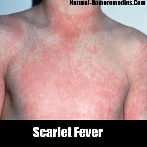 Scarlet Fever Rash On Face