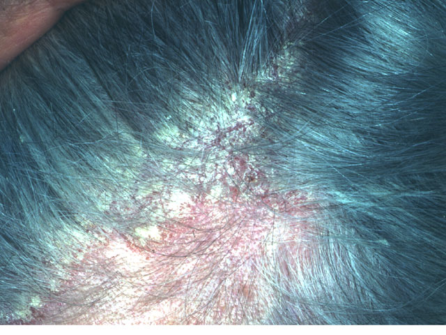 scalp skin conditions - pictures, photos