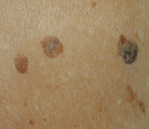 seborrheic keratoses - pictures, photos