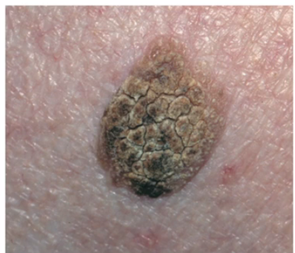 seborrheic keratosis scalp - pictures, photos