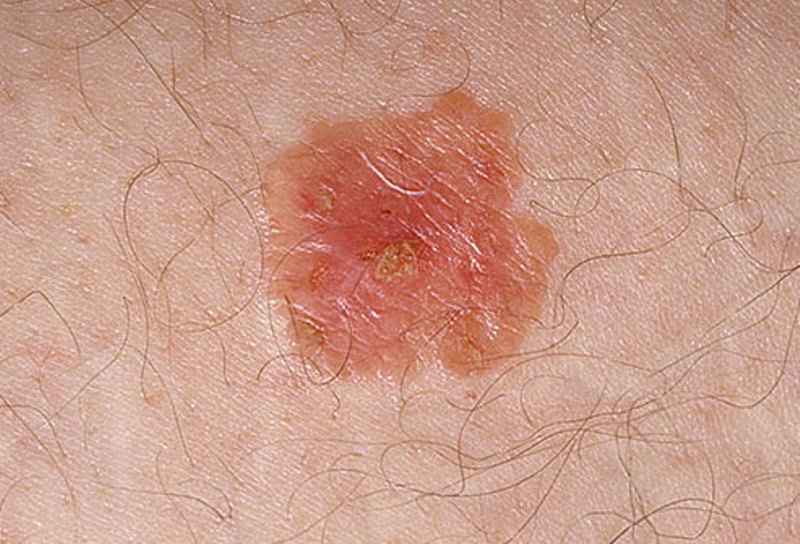 Skin Cancer White Spots 1 