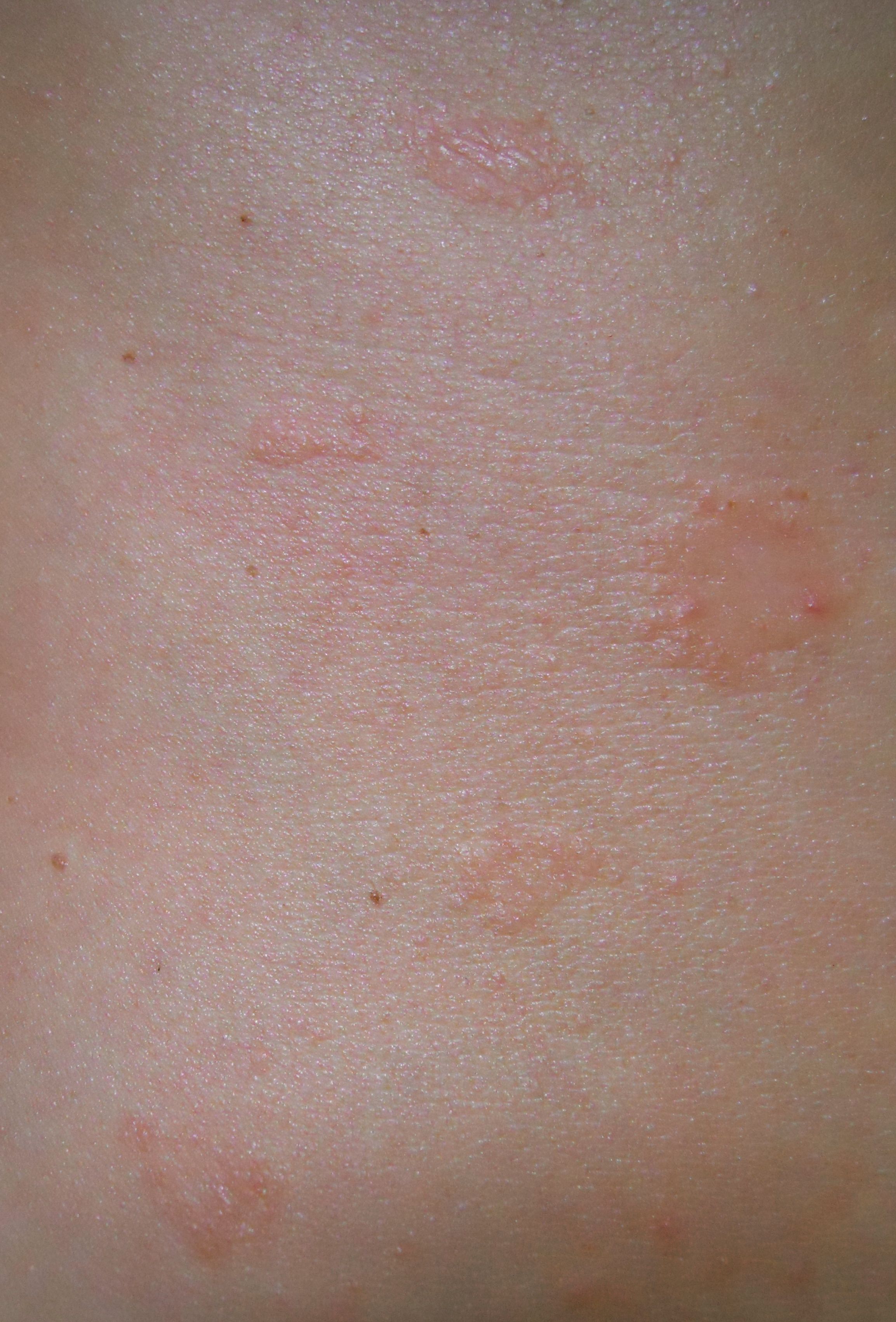 Skin Rash On Torso And Back