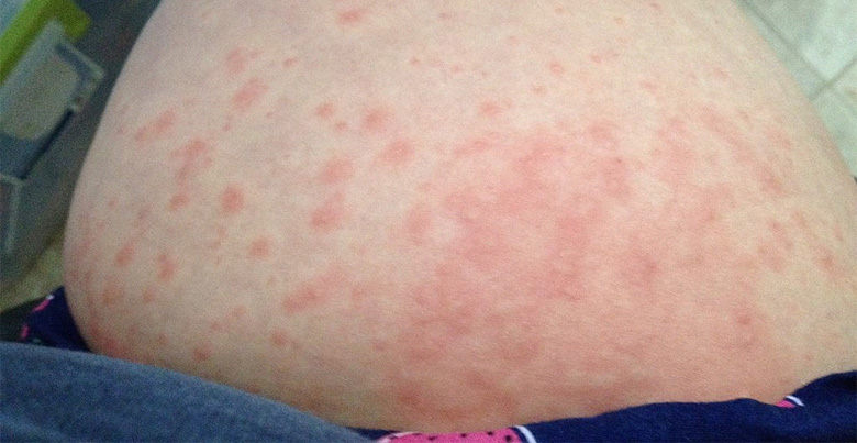 What Causes Rashes During Pregnancy