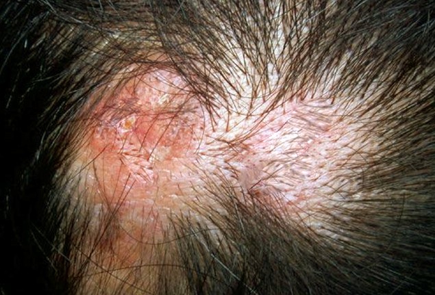 Scalp Sores Pictures Pictures Photos