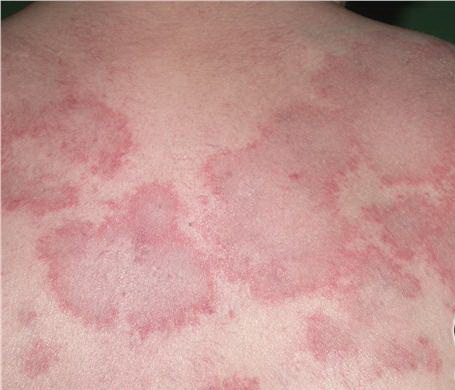 subacute cutaneous lupus erythematosus - pictures, photos