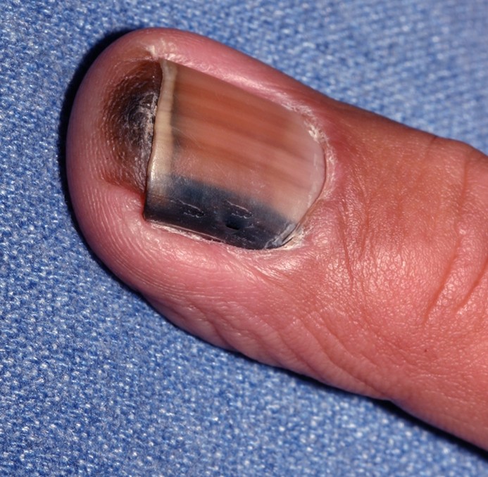 subungual-melanomas-pictures-photos