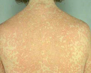 allergy sulfa reaction symptoms drugs sulfate rash antibiotic diseaeseshows