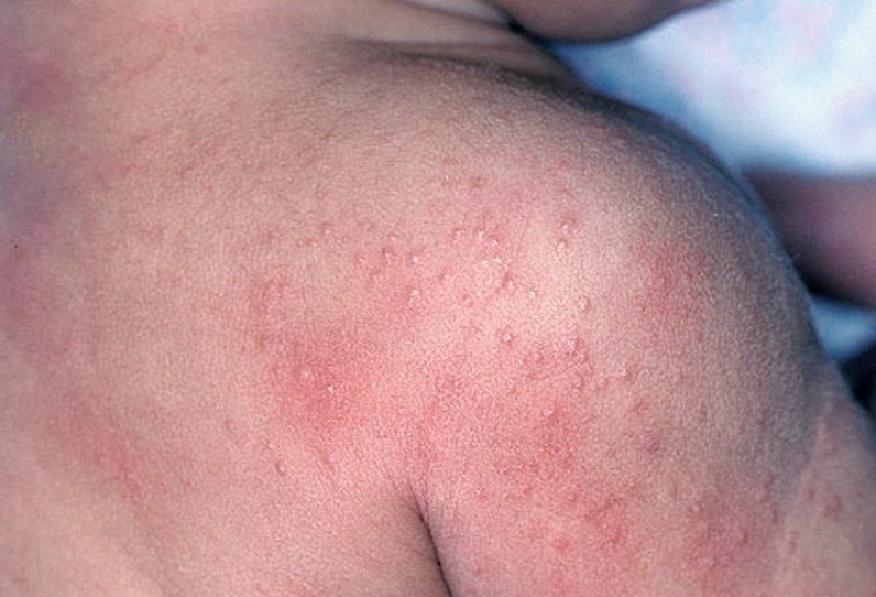 sun-allergies-rash-pictures-photos