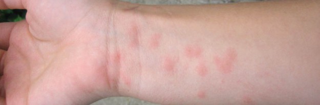 swimmers itch remedies - pictures, photos