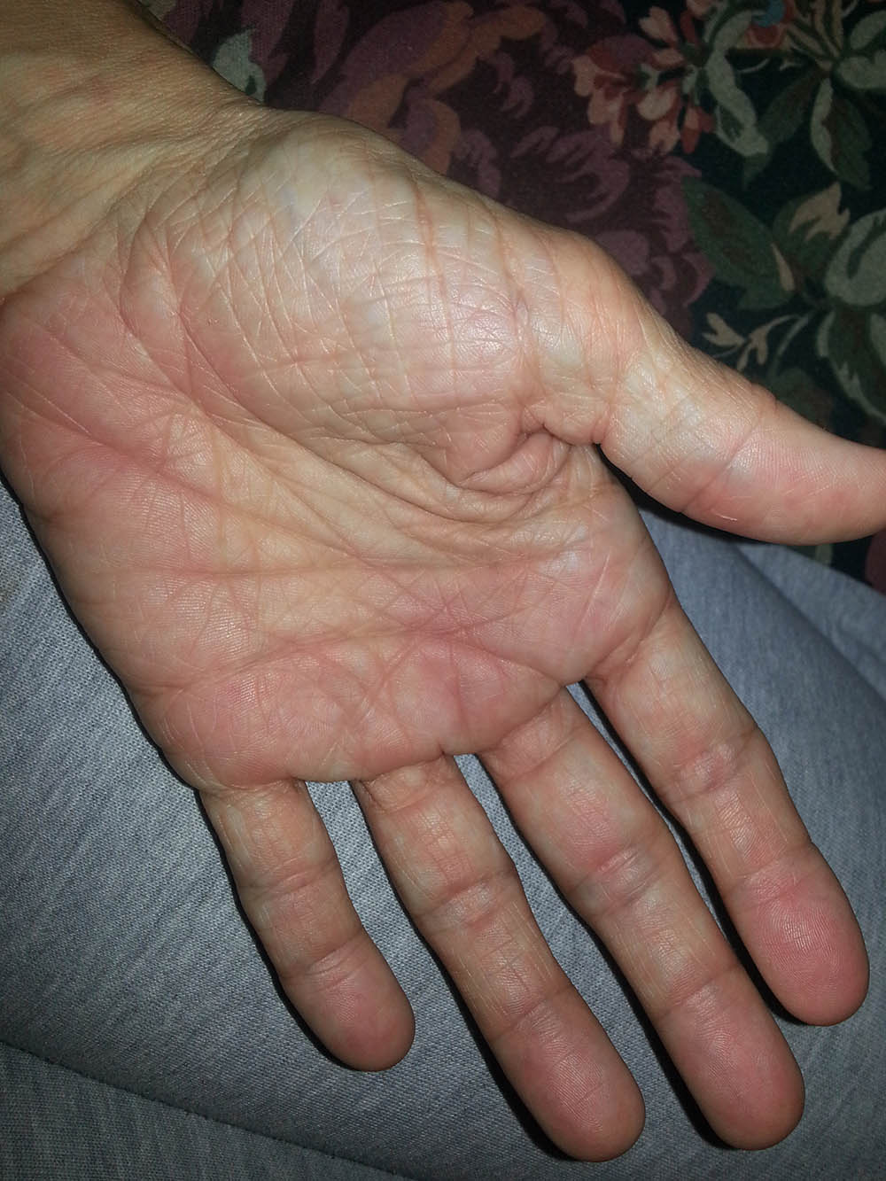 red-swollen-hand-pictures-photos