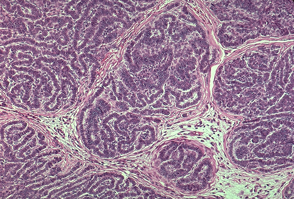 trichoblastoma - pictures, photos