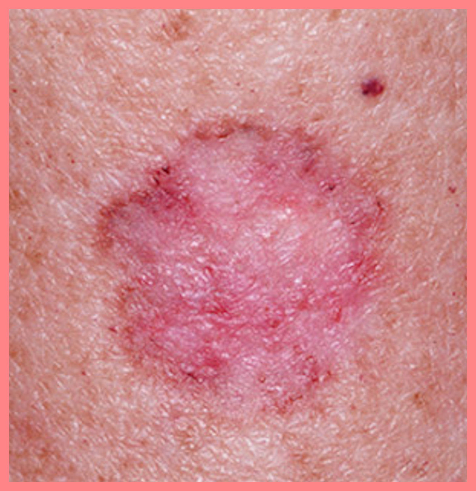  skin  disease  pic pictures photos