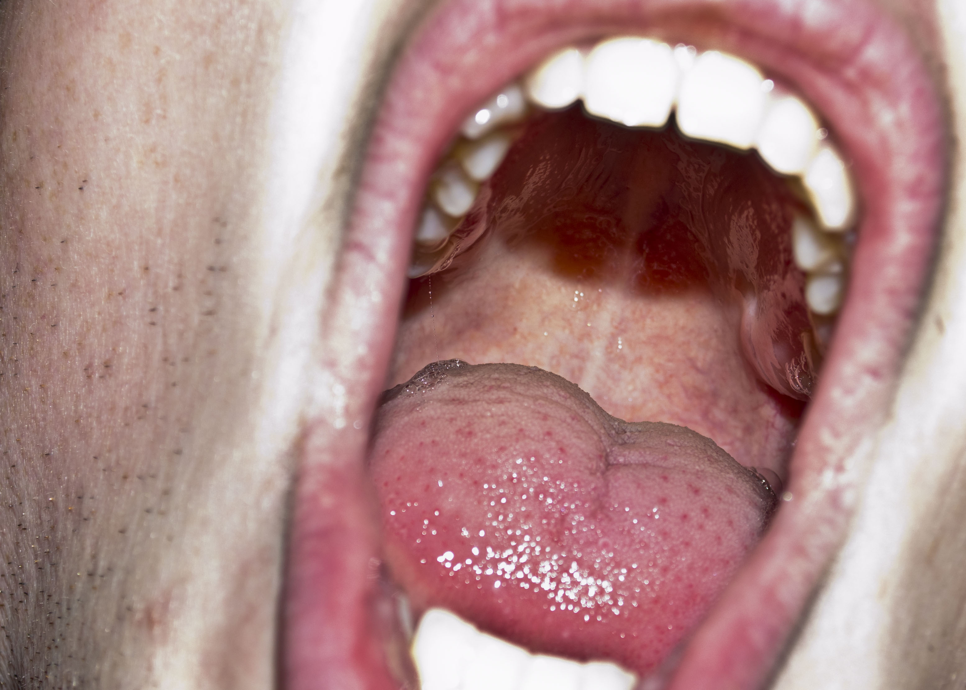 Can Oral Thrush Look Like Canker Sores