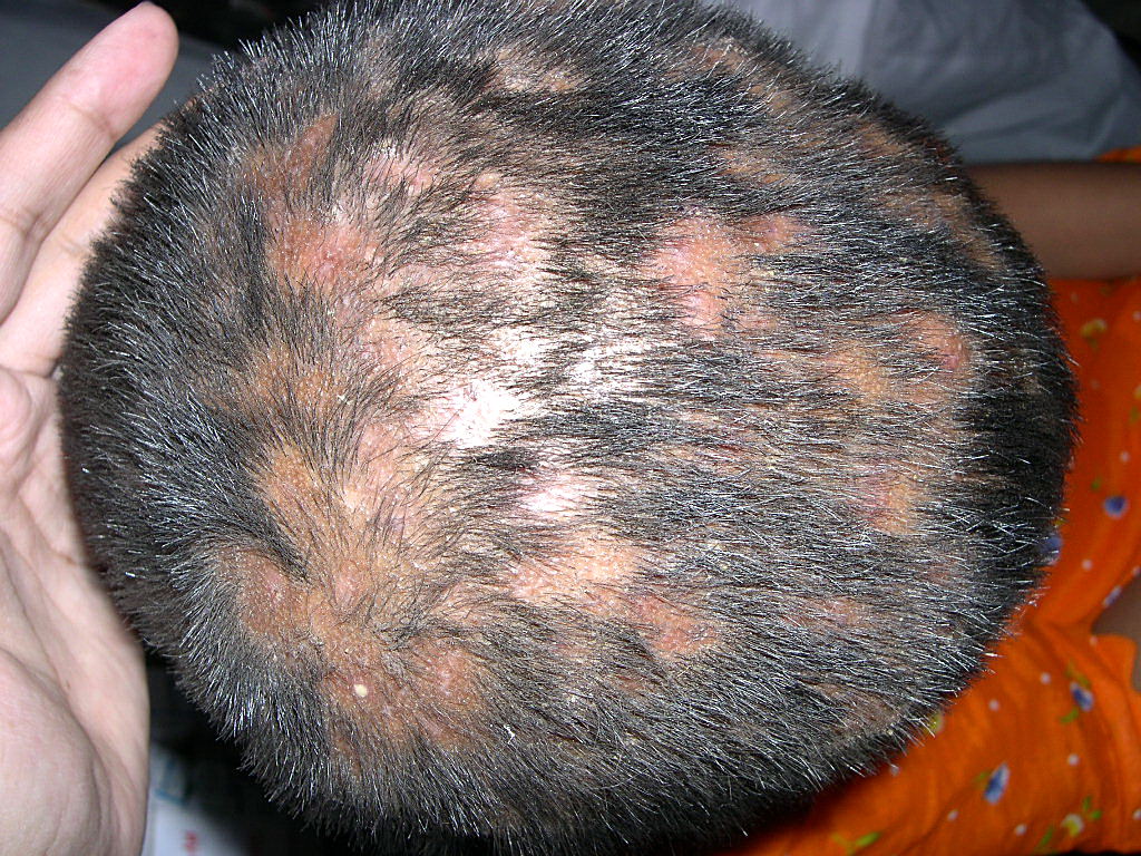 tinea capitis picture - pictures, photos
