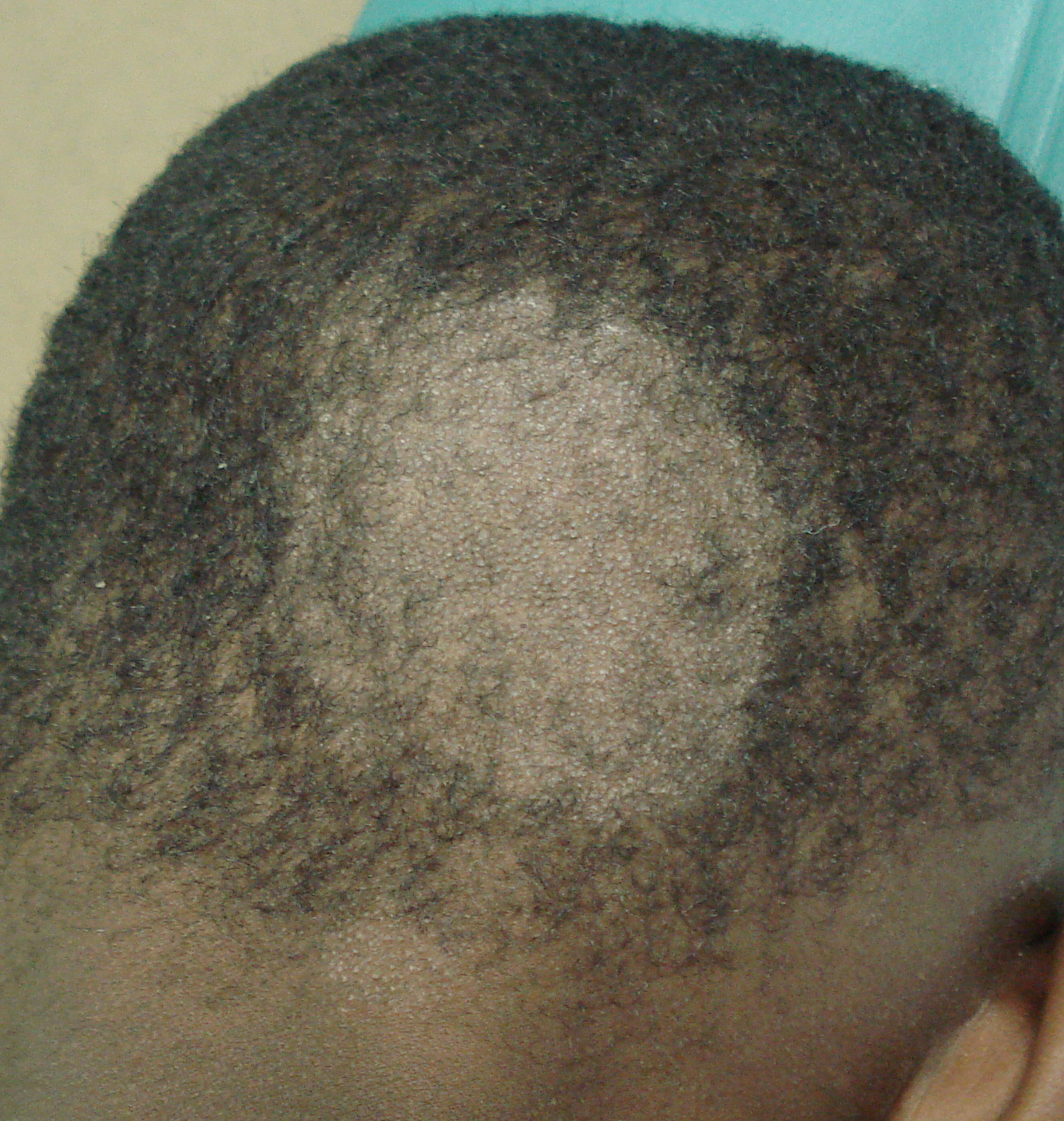 tinea capitis treatment - pictures, photos