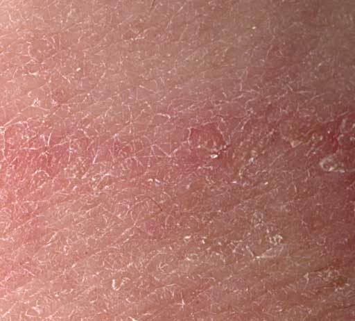 Tinea Fungal Skin Infections 