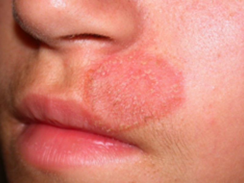 tinea on face pictures, photos