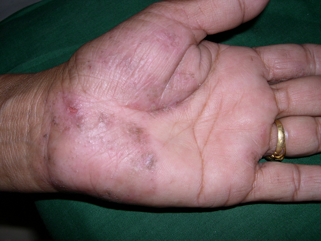 ringworm-on-hand-pictures-photos