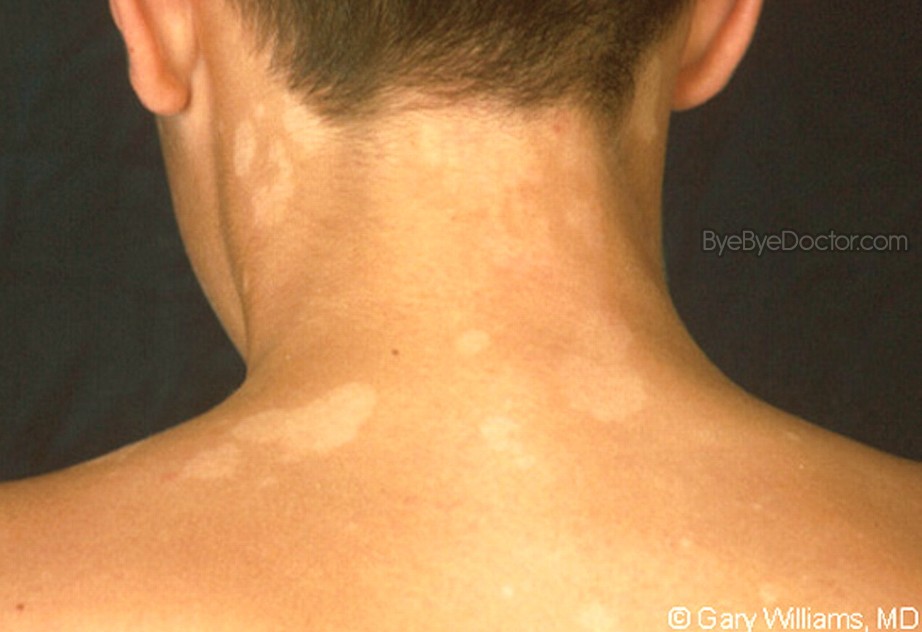 tinea versicolor on neck - pictures, photos