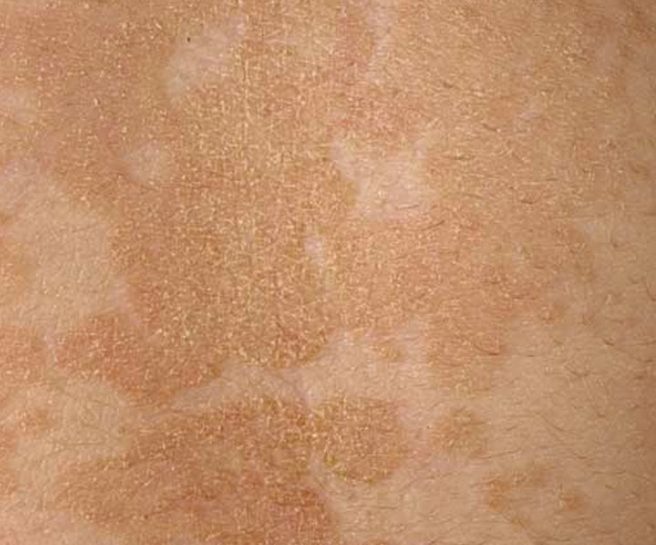 tinea versicolor causes - pictures, photos