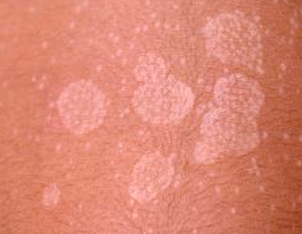 Pityriasis Versicolor - Pictures, Photos