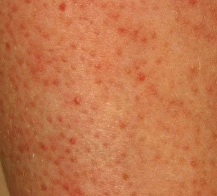 Tiny Red Spots On Skin Pictures Photos