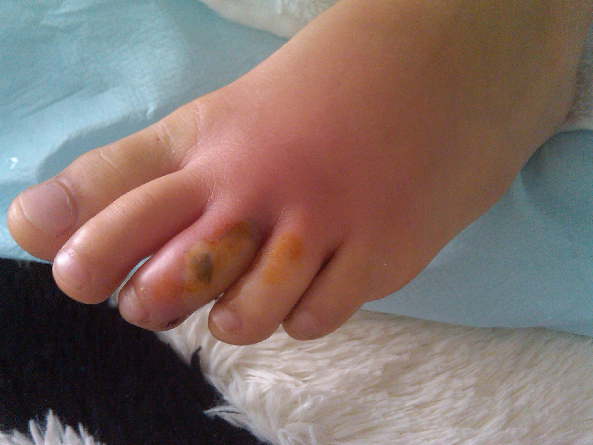 infected-toenail-pictures-photos