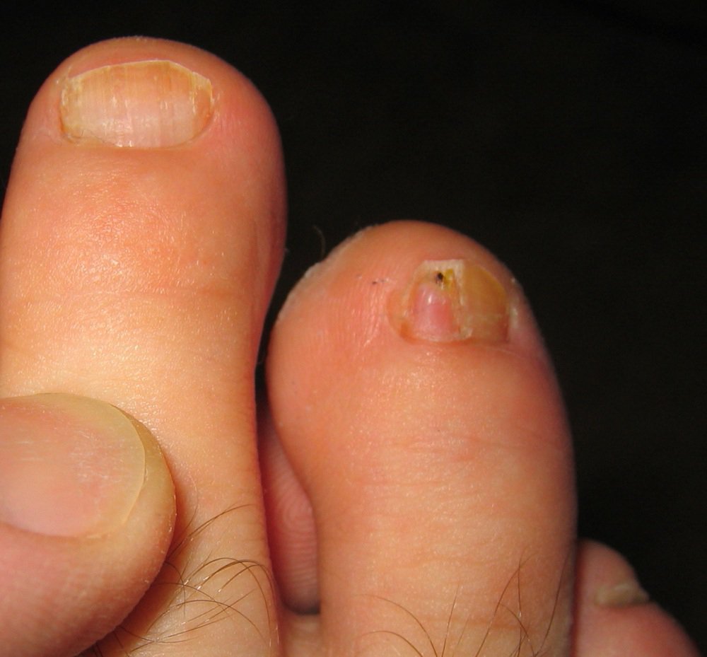 toenails cracking vertically - pictures, photos