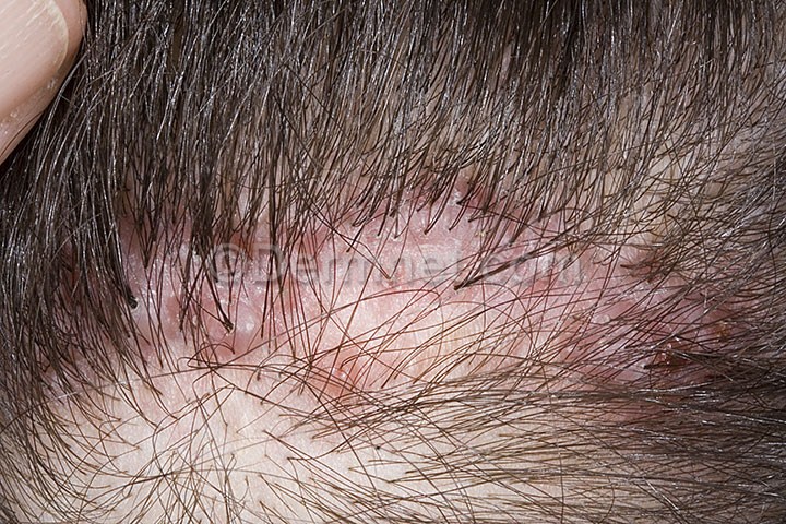 Tufted Folliculitis Pictures Photos